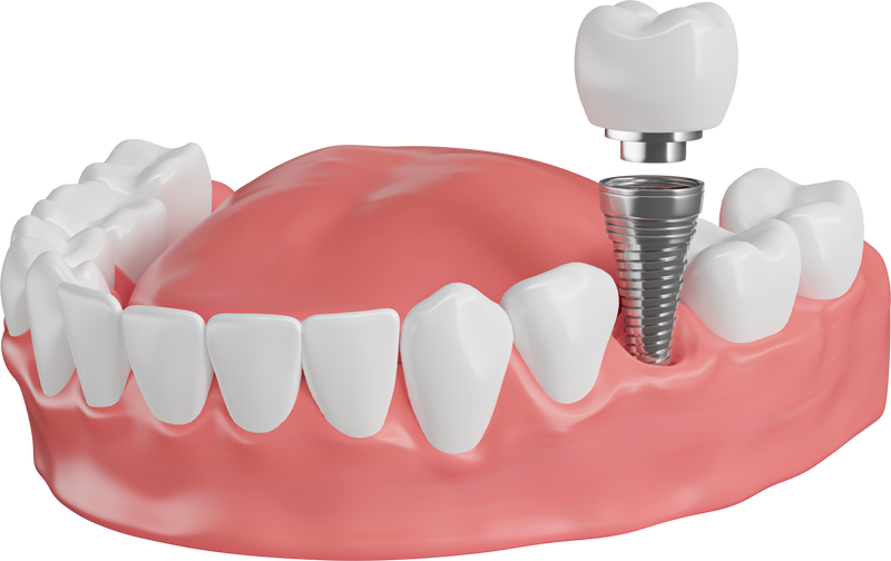 Dental Implant